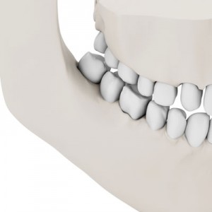 bone-graft-square