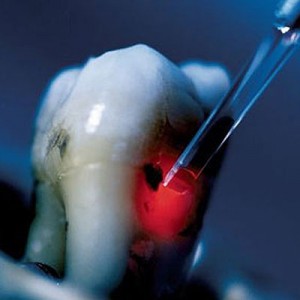 caries-id-square