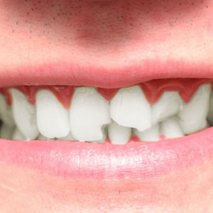 chipped-tooth-square