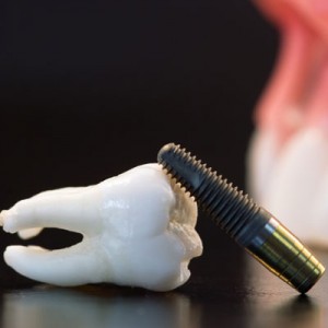 dental-implant-square