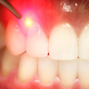 laser-dentistry-square