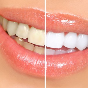 whitening-square