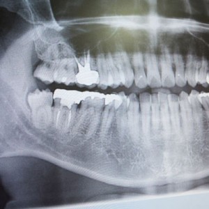 dental-xrays-square