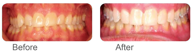 Bonding and Invisalign