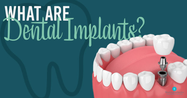 What Are Dental Implants?
