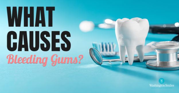 What Causes Bleeding Gums?