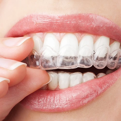 Washington Smiles Putting on Custom Mouth guard