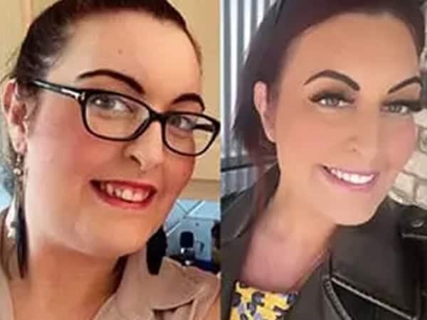Photo of a Woman Before and After Invisalign Clear Aligners